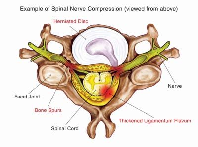 Nerve compression due to herniated disc may require ACDF