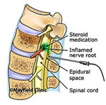 Epidural Steroid Injections