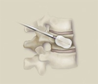 Kyphoplasty vs. Vertebroplasty: Kyphoplasty uses a balloon