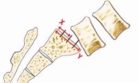 Grade 2 Spondylolisthesis
