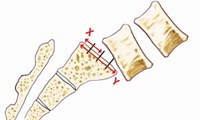 Grade 2 Spondylolisthesis