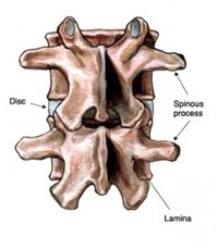Posterior cervical laminectomy removes the lamina